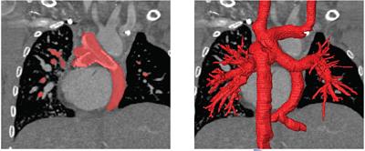 Virtual treatment planning in three patients with univentricular physiology using computational fluid dynamics—Pitfalls and strategies